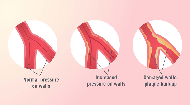 what-is-high-blood-pressure-livongo